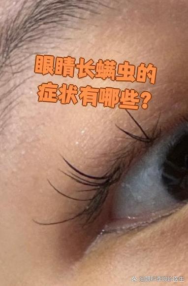 眼睛有螨虫的症状