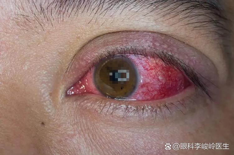 眼睛长螨虫的症状有哪些