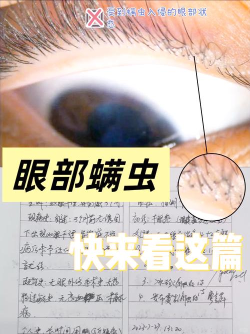 怎么判断眼睛有螨虫