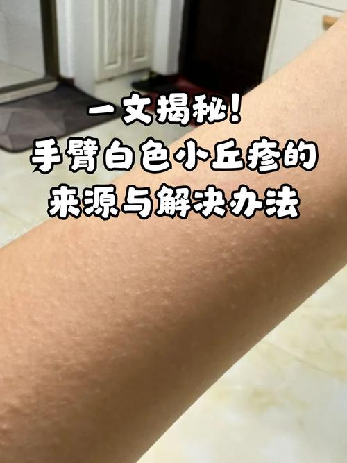 胳膊上许多小疙瘩,有时挤一挤里面就有白色的物体出来,那是什么,怎么治...