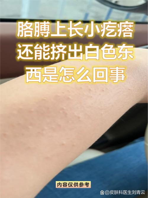 脸上的痘痘挤出来的白色小米粒是什么