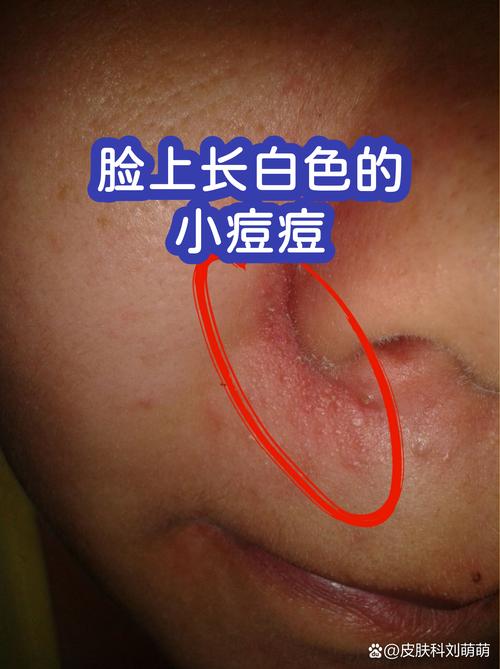 狗身上有个疙瘩,上面有个洞,挤出来很多白颜色东西,是怎么回事