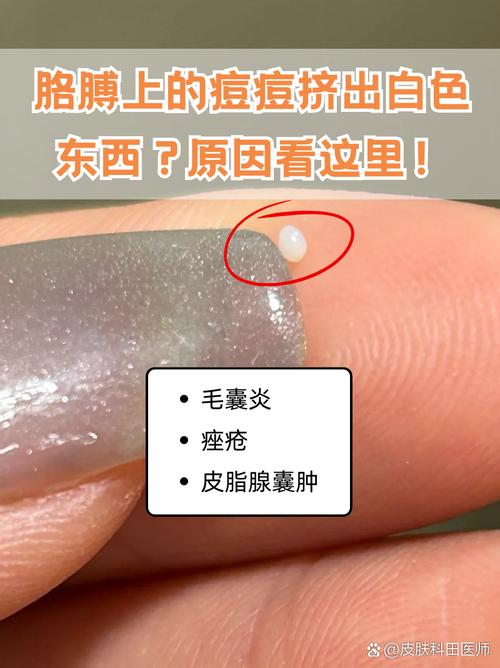 脸上痘痘挤出来的白色东西是什么
